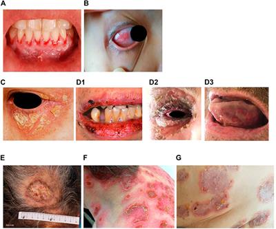 Autoimmune Pemphigus: Latest Advances and Emerging Therapies